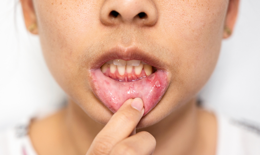 Soft Tissue Injuries